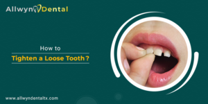 How to Tighten a Loose Tooth - Allwyn Dental